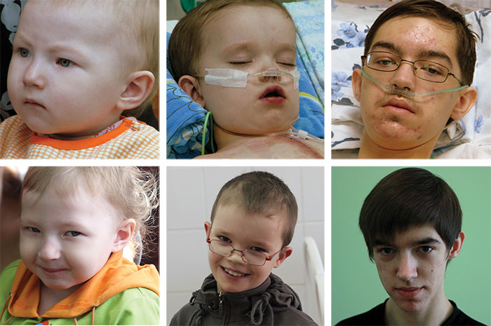 Before and after photos of Dasha, Nikolai, and Roman, three children who received heart surgery from Heart to Heart